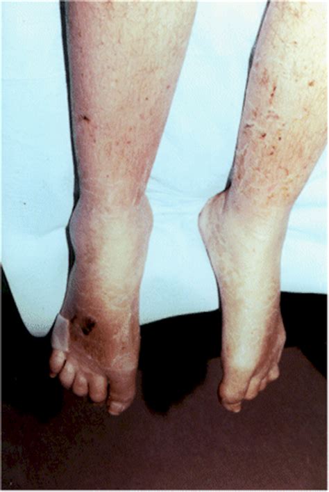 soap2day.rsd|pictures of rsd in foot.